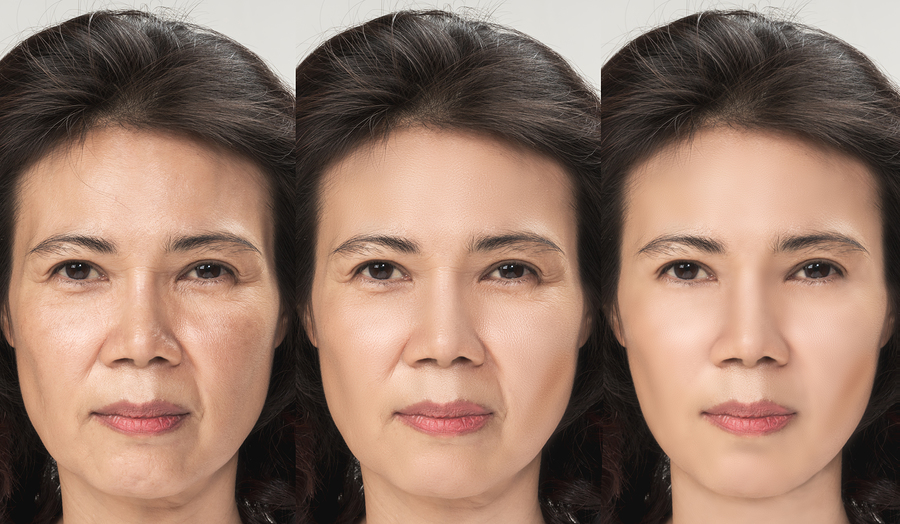 Anti Aging Process, Asian Woman Face Skin With Anti-aging Proced
